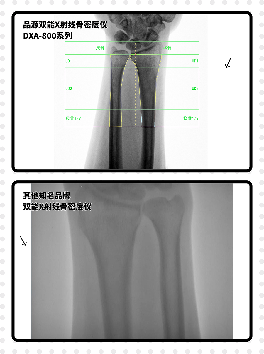 高清成像，毫厘毕现 | 双能X射线骨密度仪，如何重塑骨骼检测的清晰度？